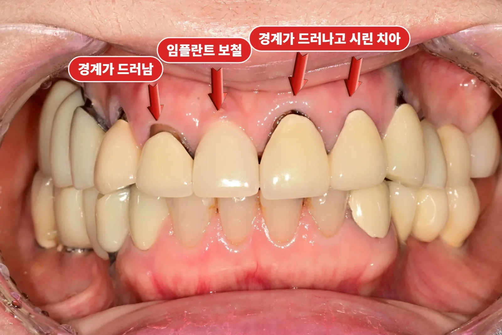 치료 전 정면 — 잇몸 경계가 어두운 기존 앞니 크라운