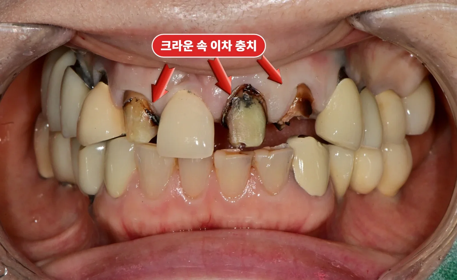 크라운 제거 직후 — 신경이 죽어 변색되고 잇몸 아래까지 진행된 충치