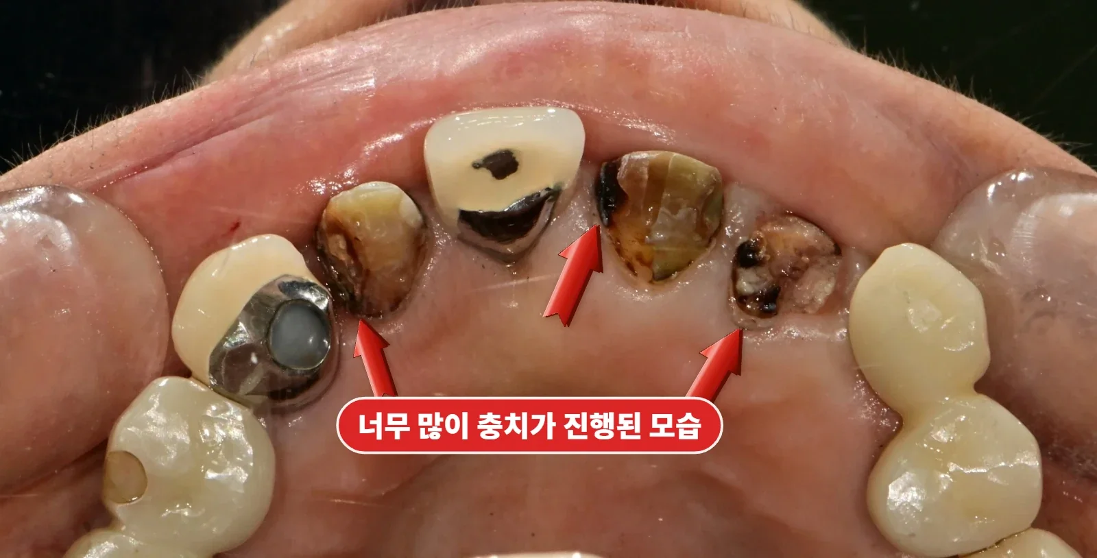 크라운 제거 직후 근접 — 잇몸 선 아래까지 내려간 충치