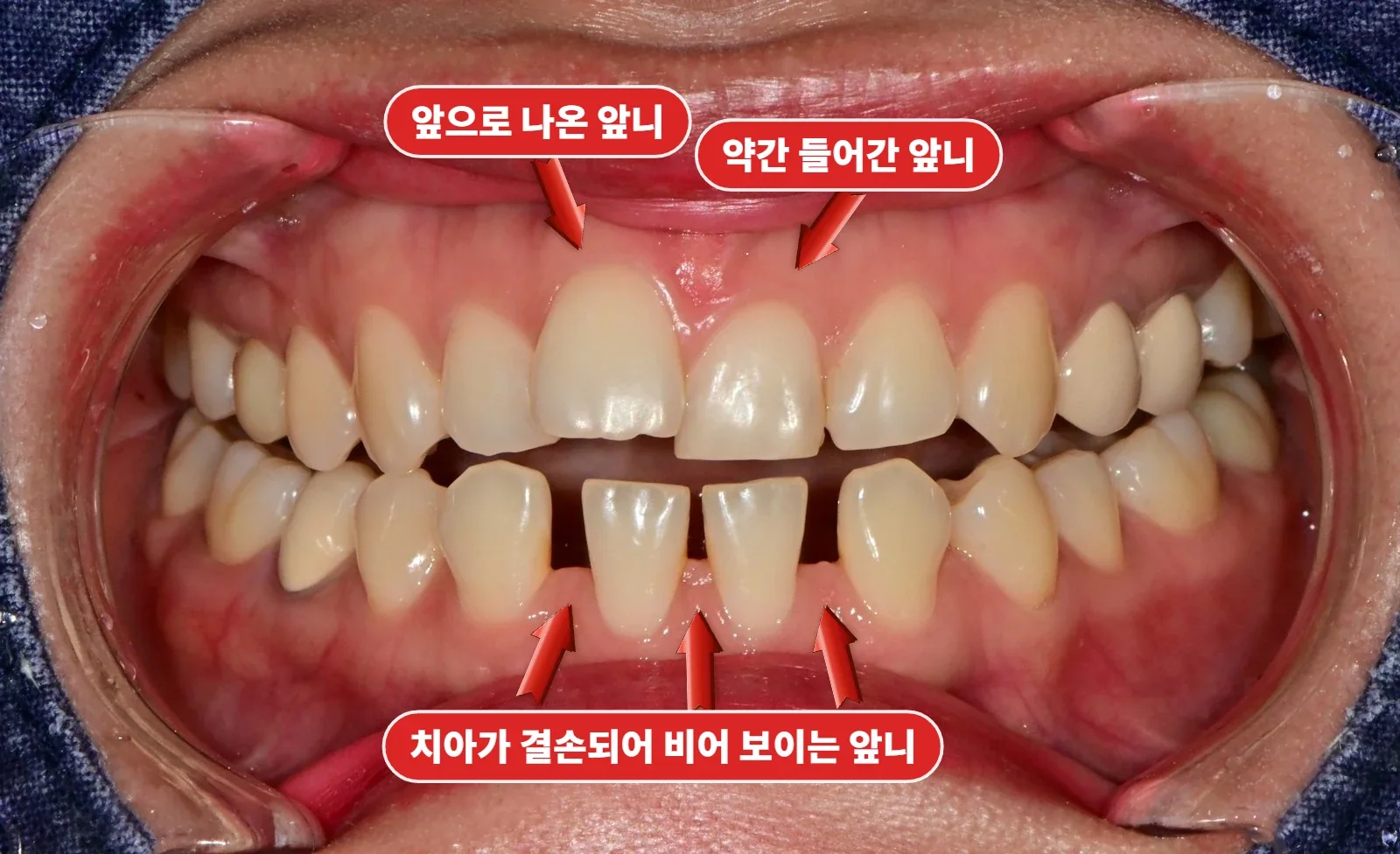 초진 정면 — 위·아래 앞니 배열과 사이 공간