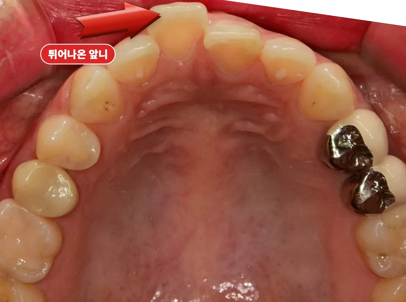 위에서 본 위 앞니 — 한쪽 앞니가 앞으로 나온 정도