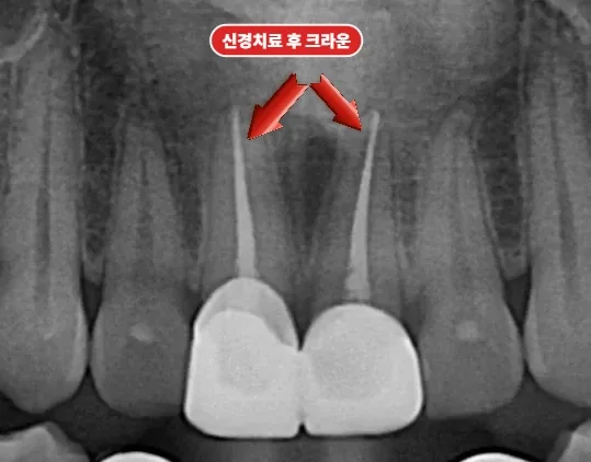 위 앞니 신경치료 후 크라운을 올린 엑스레이