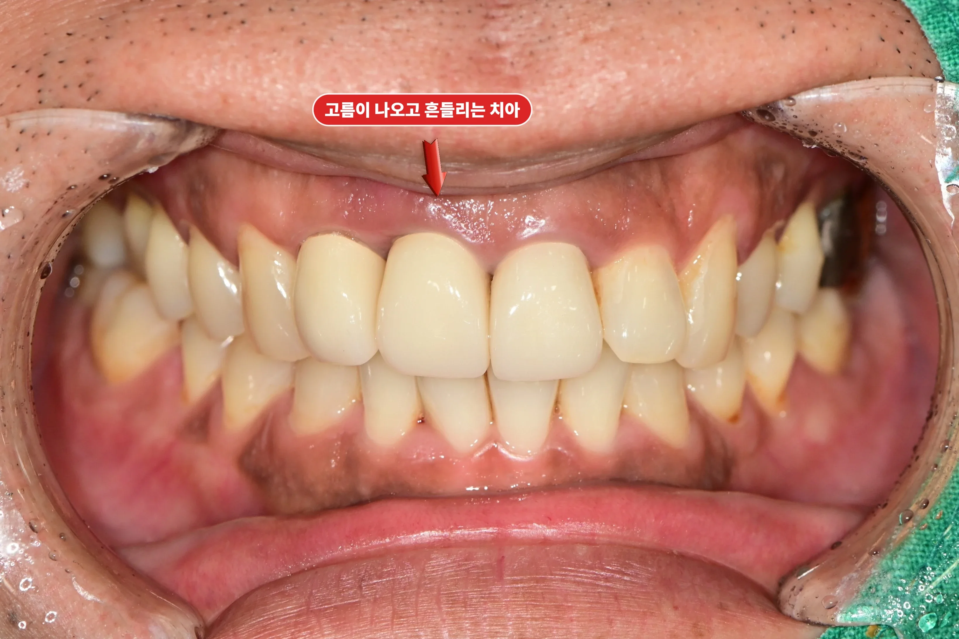 앞니 동요와 잇몸 문제가 있던 치료 전 정면