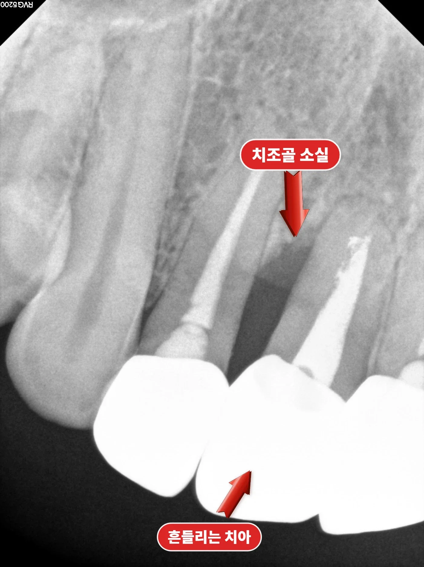 잇몸뼈가 무너진 앞니의 발치 전 X-ray
