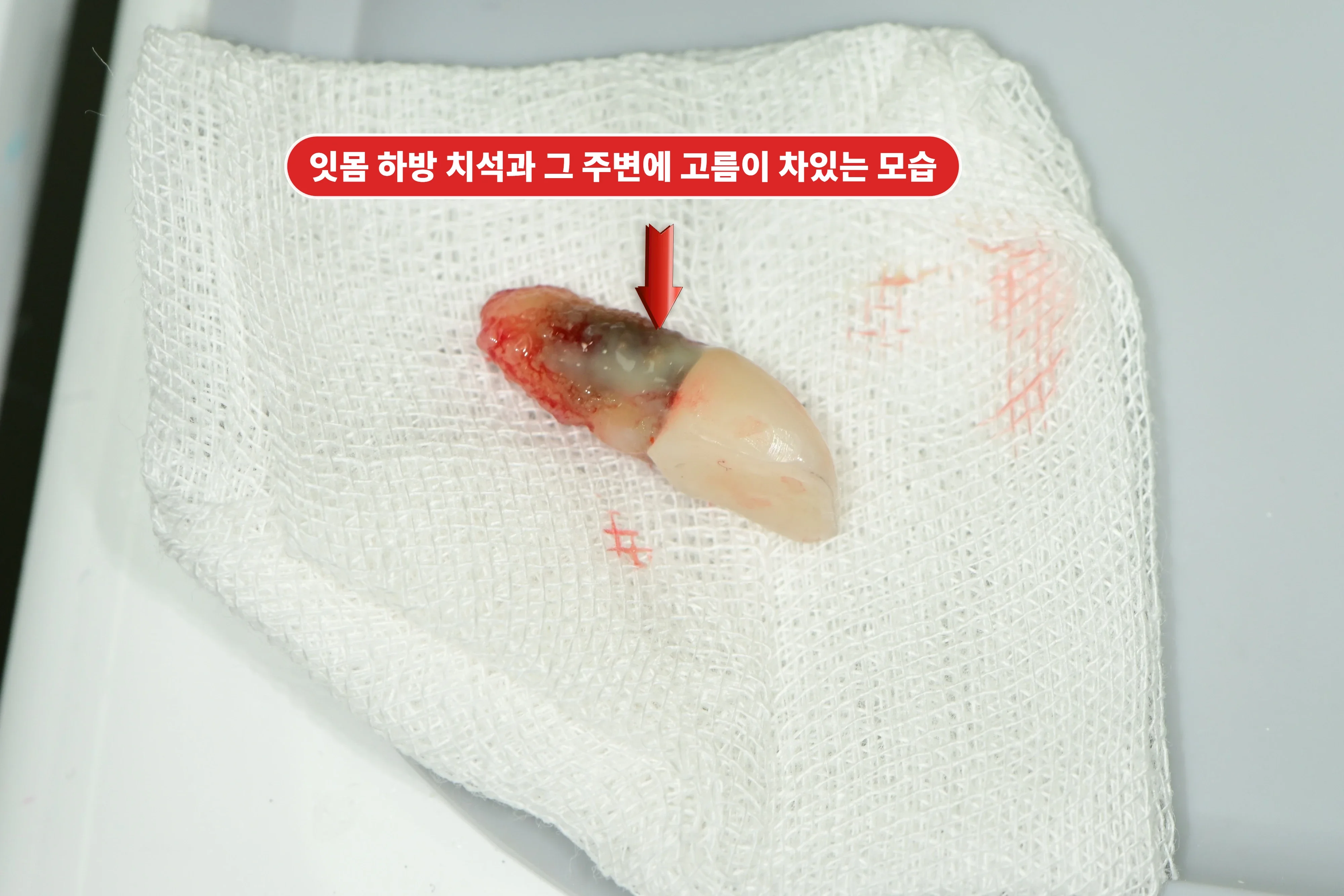 염증 조직이 붙은 채 발치된 앞니