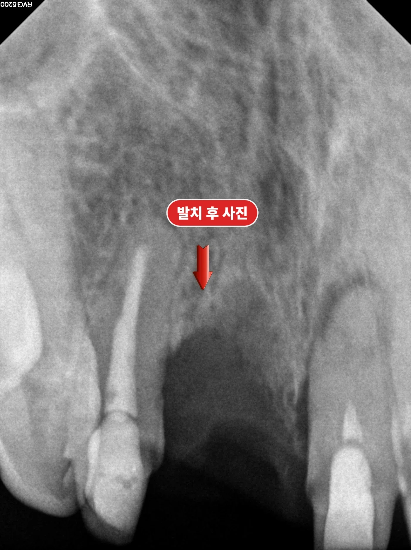 발치와 뼈이식 후 X-ray