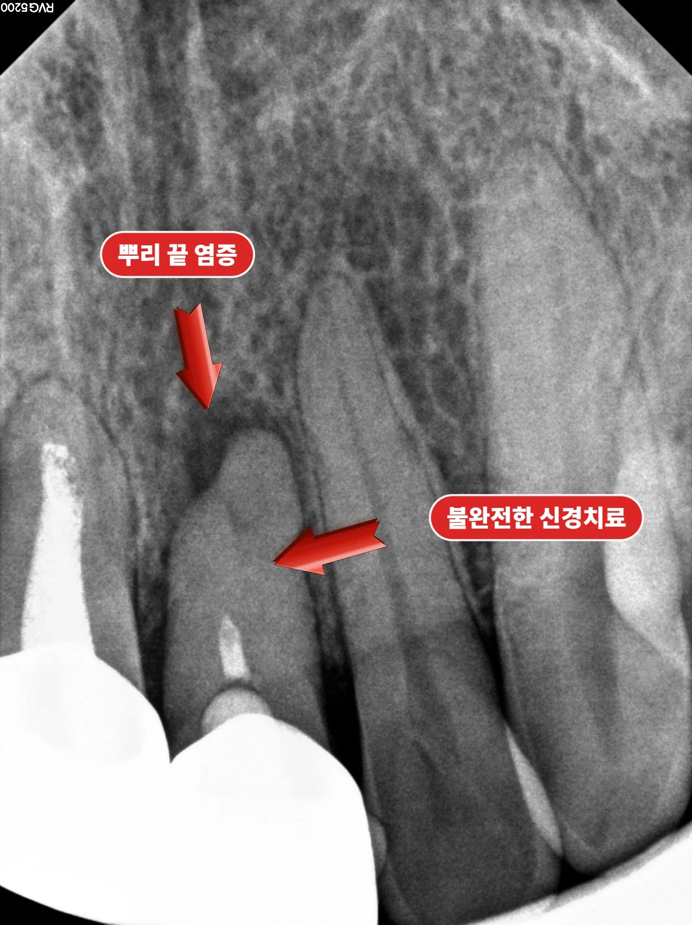 뿌리 끝 염증이 보이는 옆 앞니 X-ray
