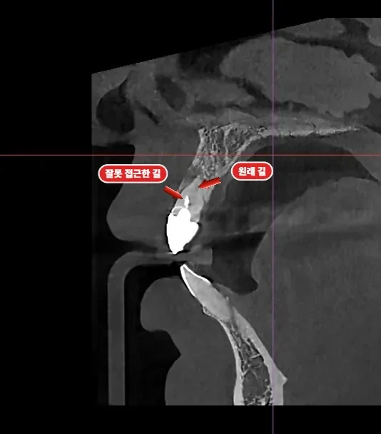 기존 신경치료 통로가 실제 신경관과 다른 것이 보이는 CT