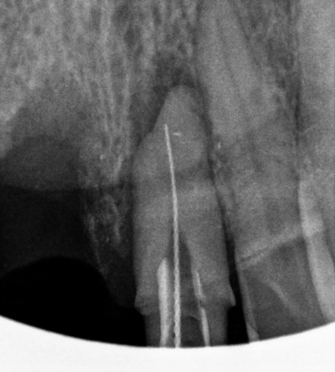 재신경치료 중 신경관 길이 확인 X-ray