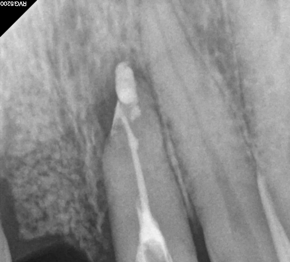 뿌리 끝까지 채워진 최종 근관충전 X-ray