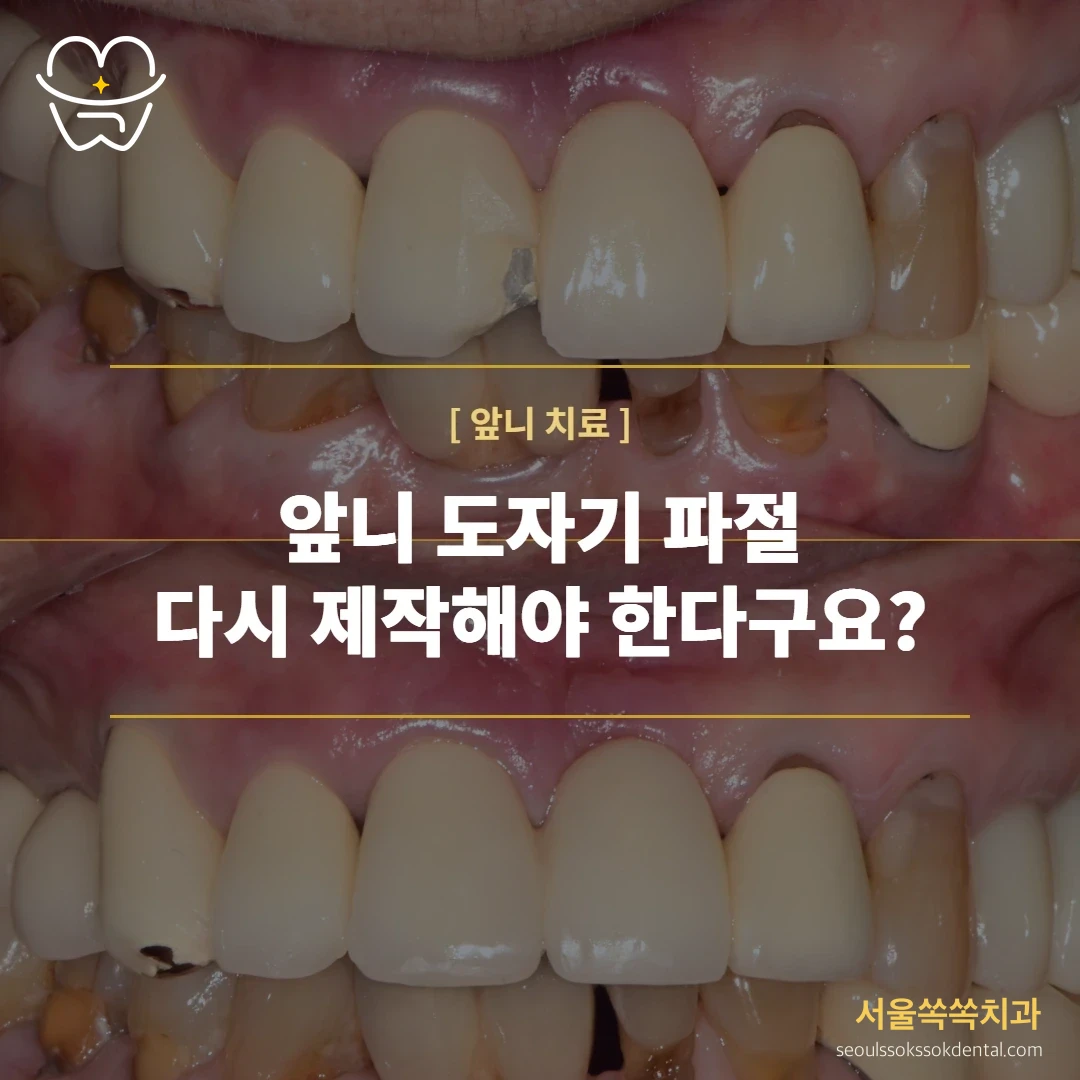 앞니 보철 도자기가 깨졌는데, 전체를 다시 씌워야만 할까?