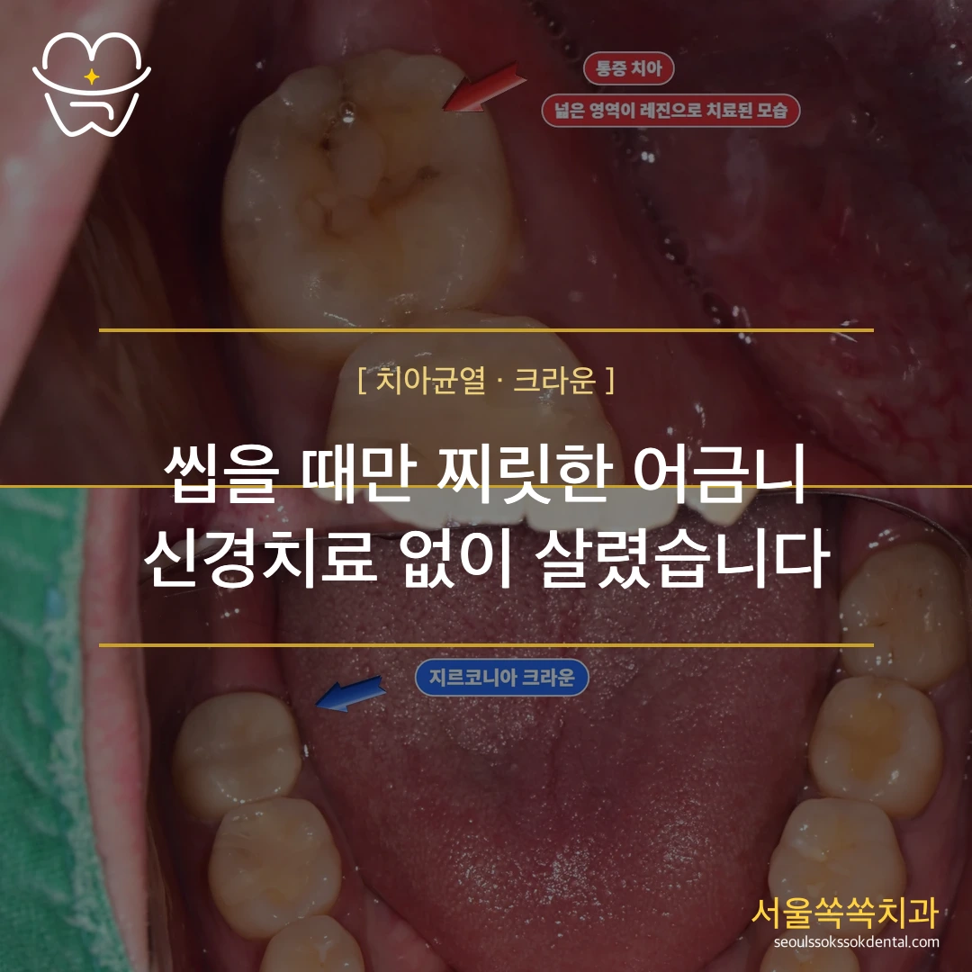 씹을 때만 찌릿한 어금니 — 치아균열증후군, 신경치료 없이 크라운으로 해결하기까지