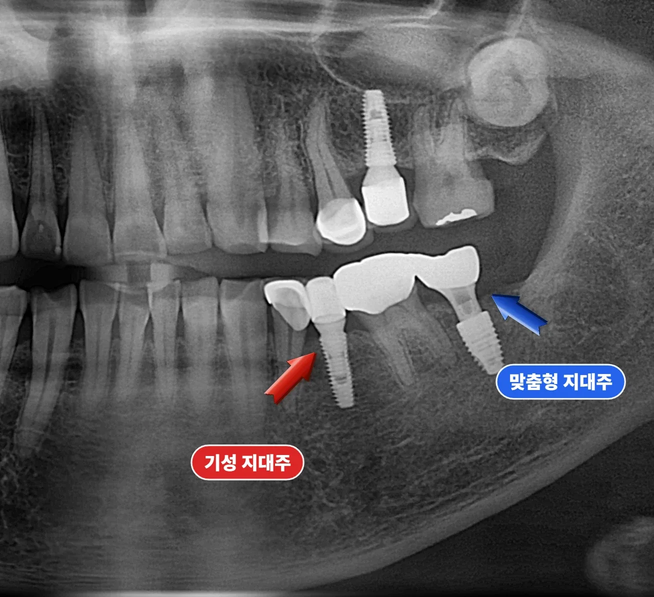 초진 파노라마 — 기존 임플란트 보철과 기성 지대주 상태
