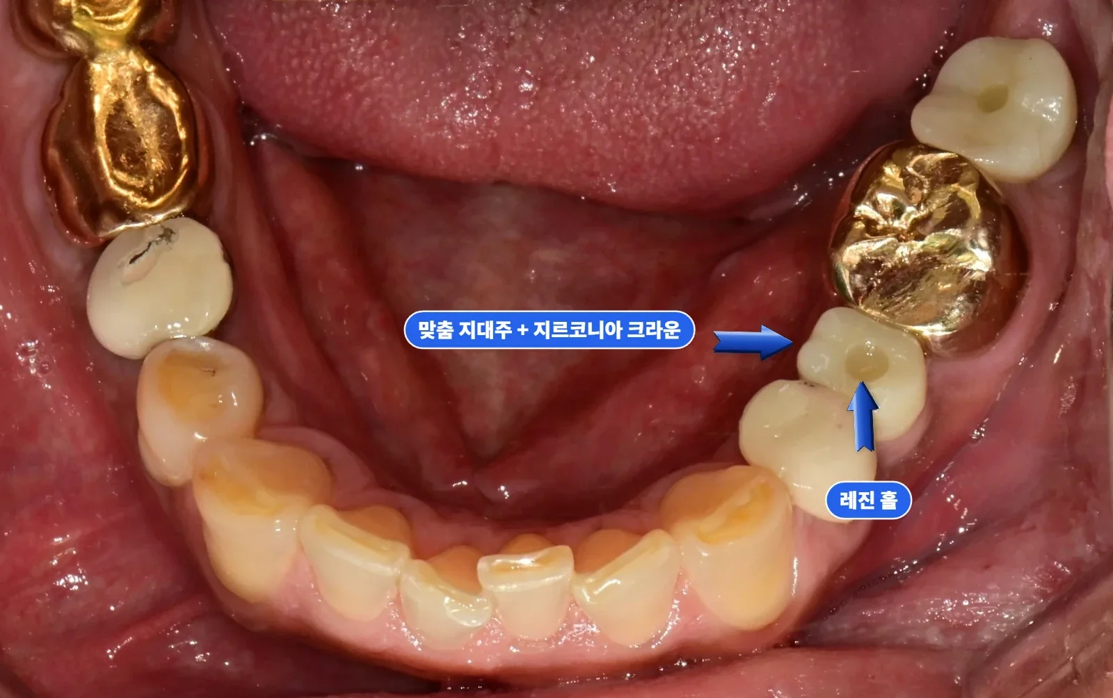 최종 아래 교합면 — 나사 고정(SCRP) 방식 지르코니아 보철