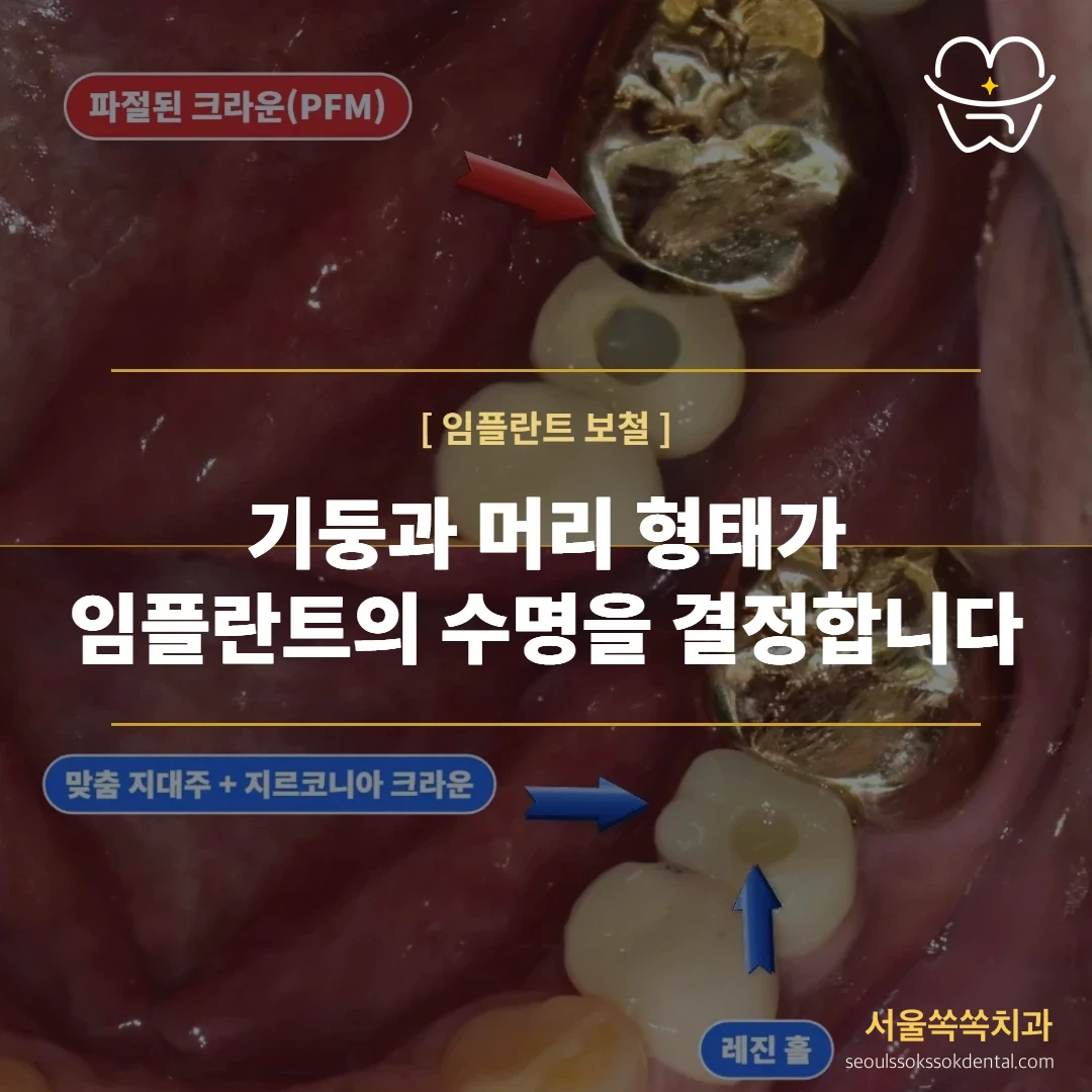 임플란트 지대주와 크라운을 다시 만든 보철 재제작 실제 진료 기록