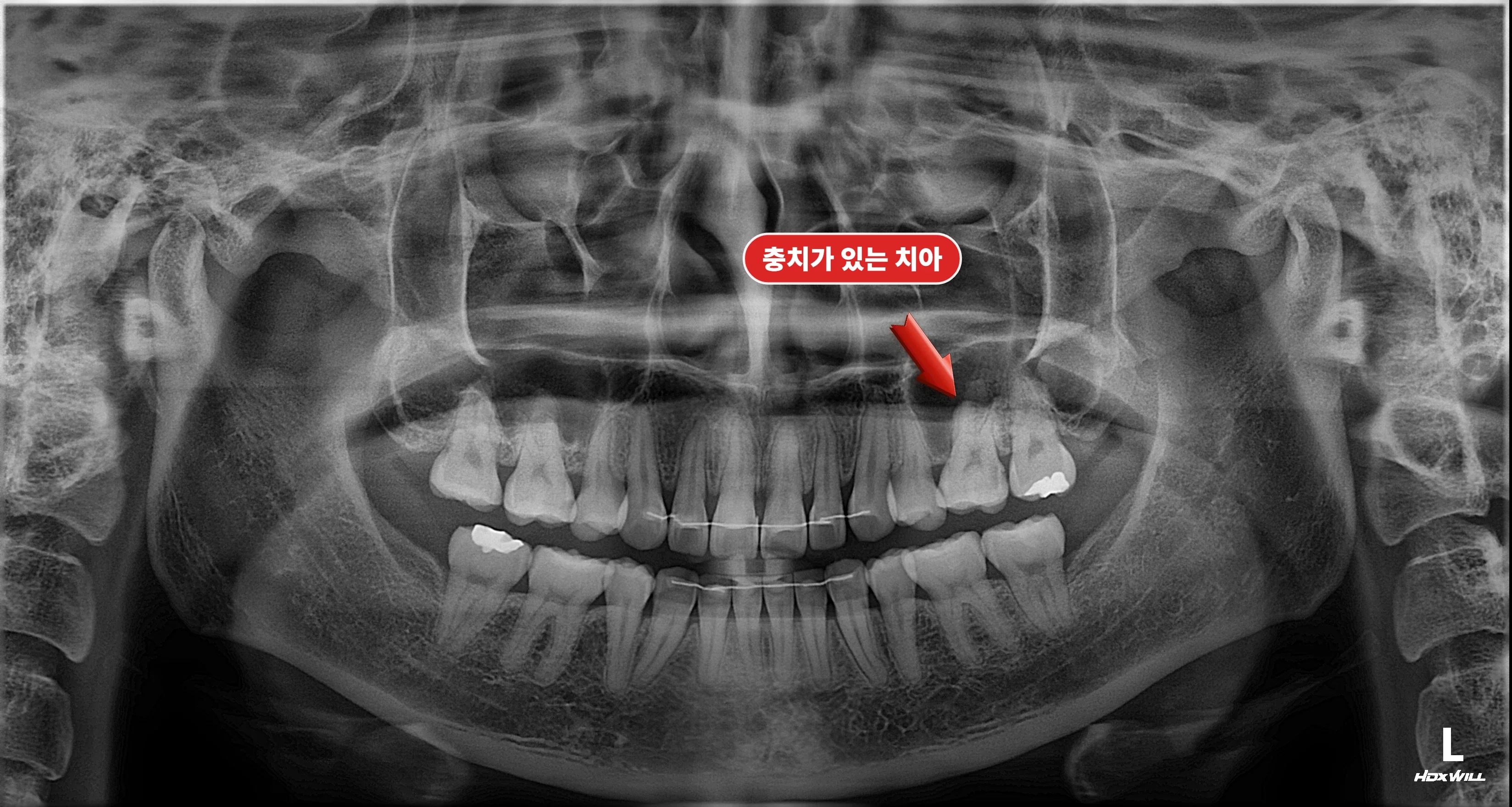 어금니 충치 진단 전 초진 파노라마, 전체 구강 상태 확인