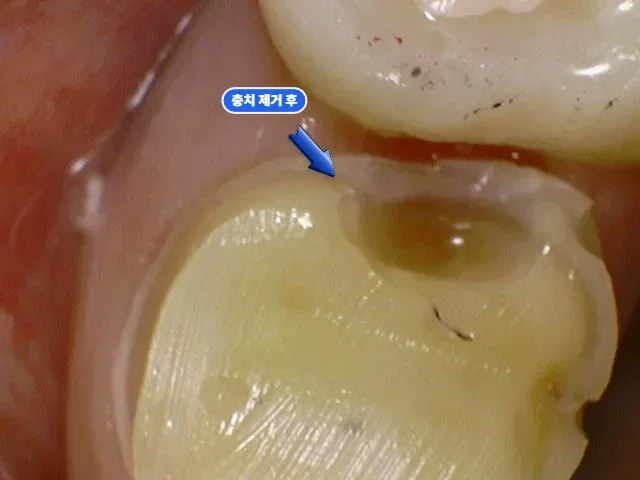 충치와 기존 레진을 걷어낸 직후 어금니 구강카메라 사진, 충치 제거 후 라벨