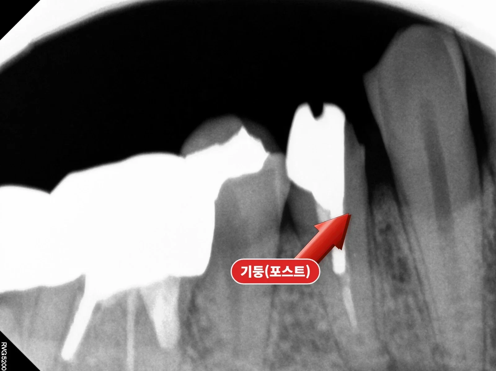 재신경치료 — 기존 크라운·금속 포스트 제거 후 방사선 사진