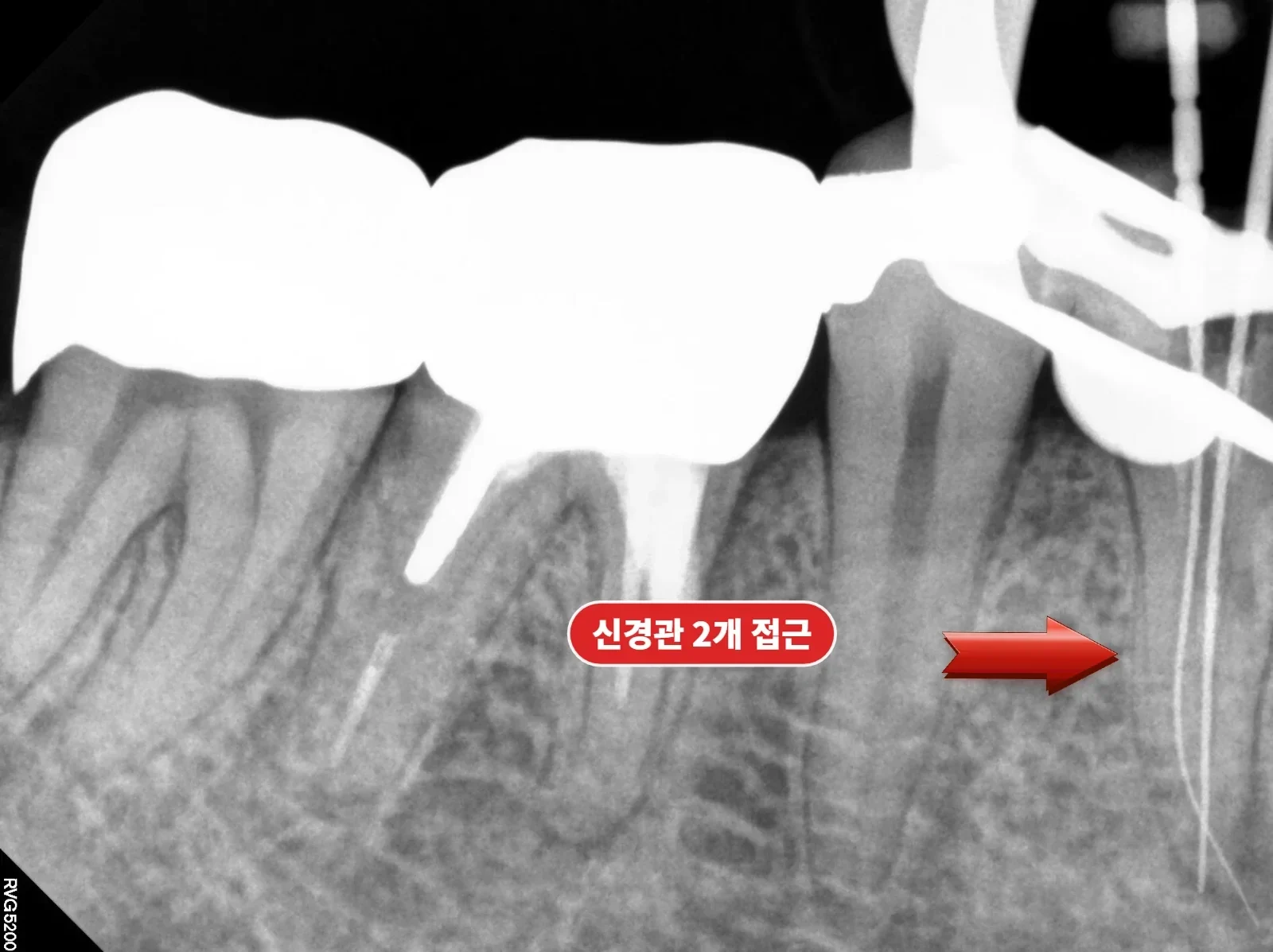 재신경치료 — 두 개의 신경관을 모두 찾은 방사선 사진