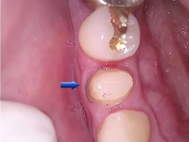 재신경치료 후 보철을 위한 치아 형태 다듬기(프렙)
