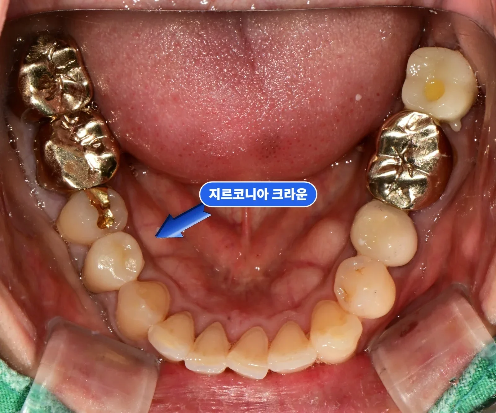 치료 종료 — 하악 교합면 사진