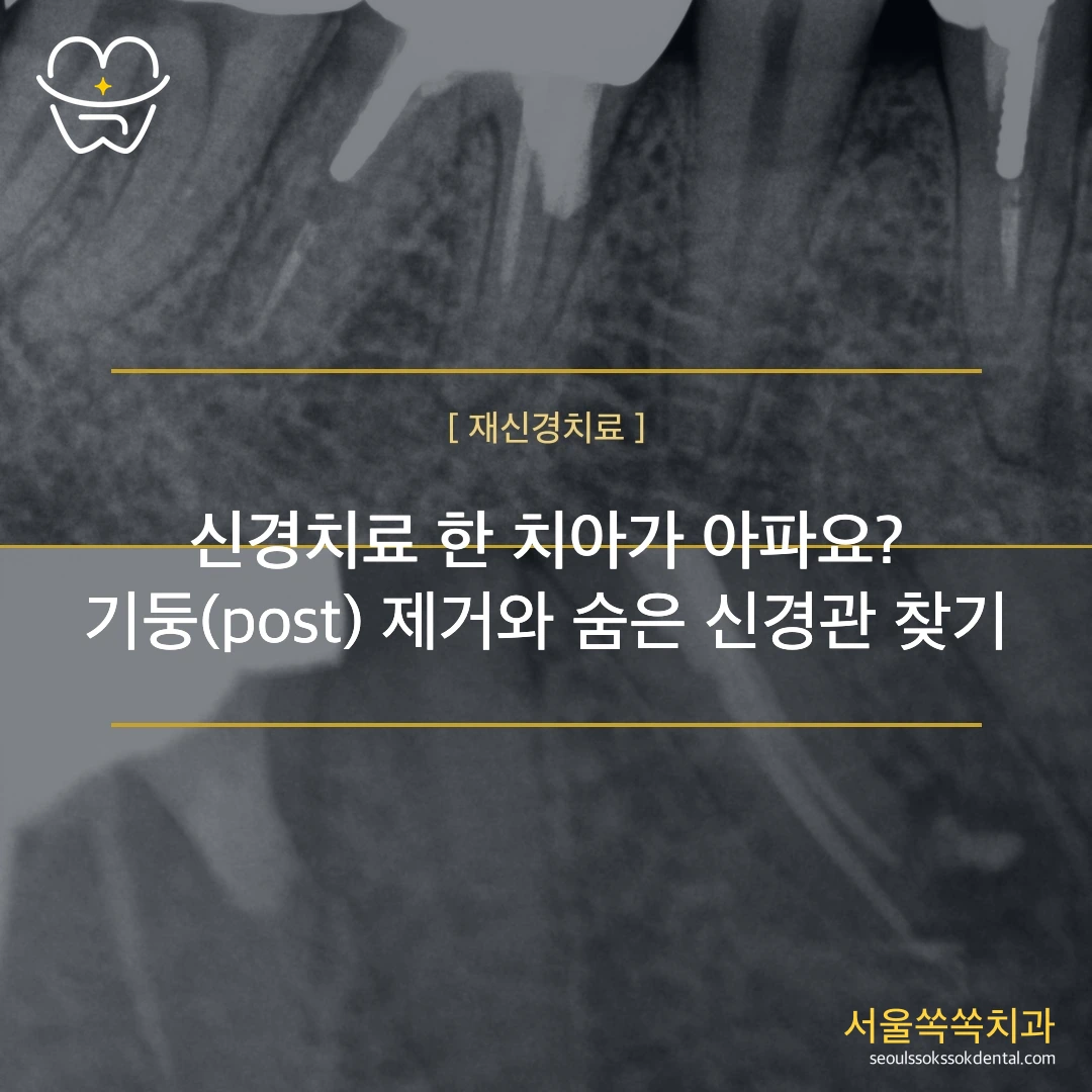 신경치료를 했는데 왜 또 아플까요? — 기둥(포스트)을 뽑고 '숨은 신경관'까지 찾아낸 재신경치료 이야기