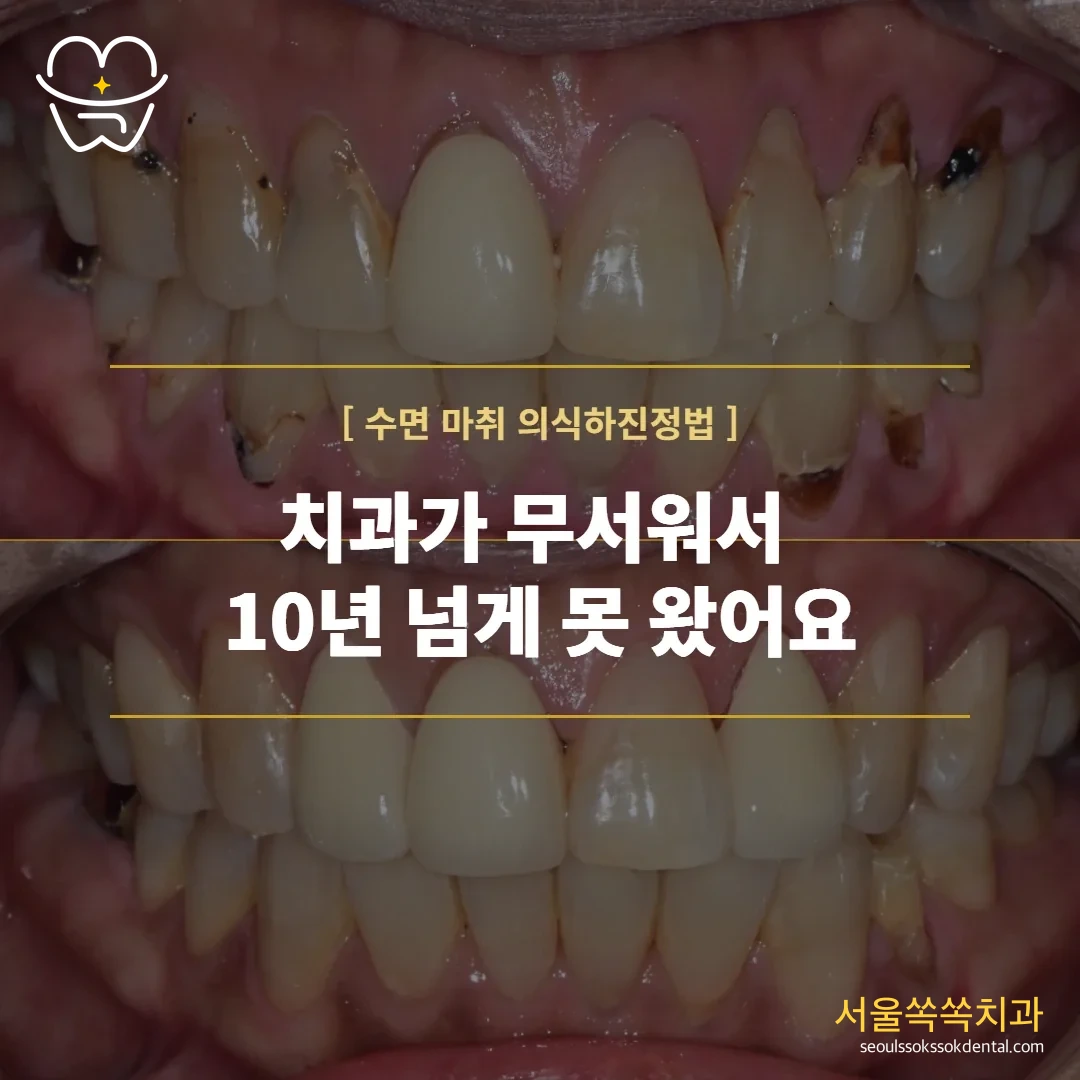 치과가 무서워 10년 넘게 못 오셨던 분, 의식하 진정요법(수면)으로 한 번에