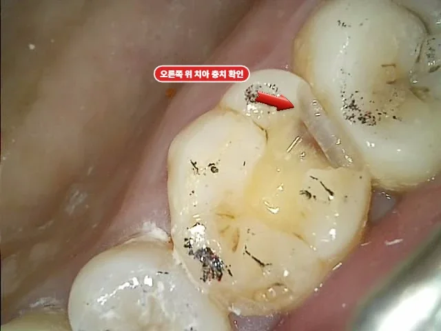 어금니 인접면 충치 직접 확인 세라믹 인레이 준비