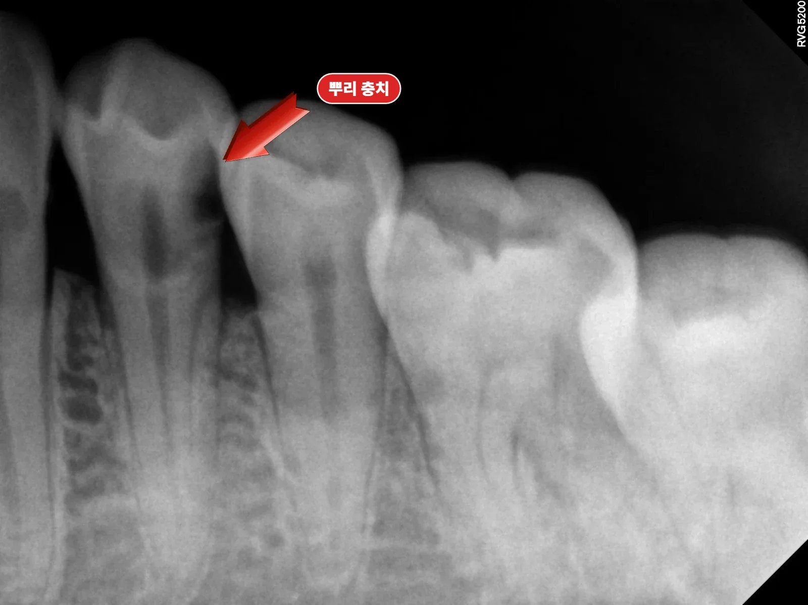 #34 root caries 모습