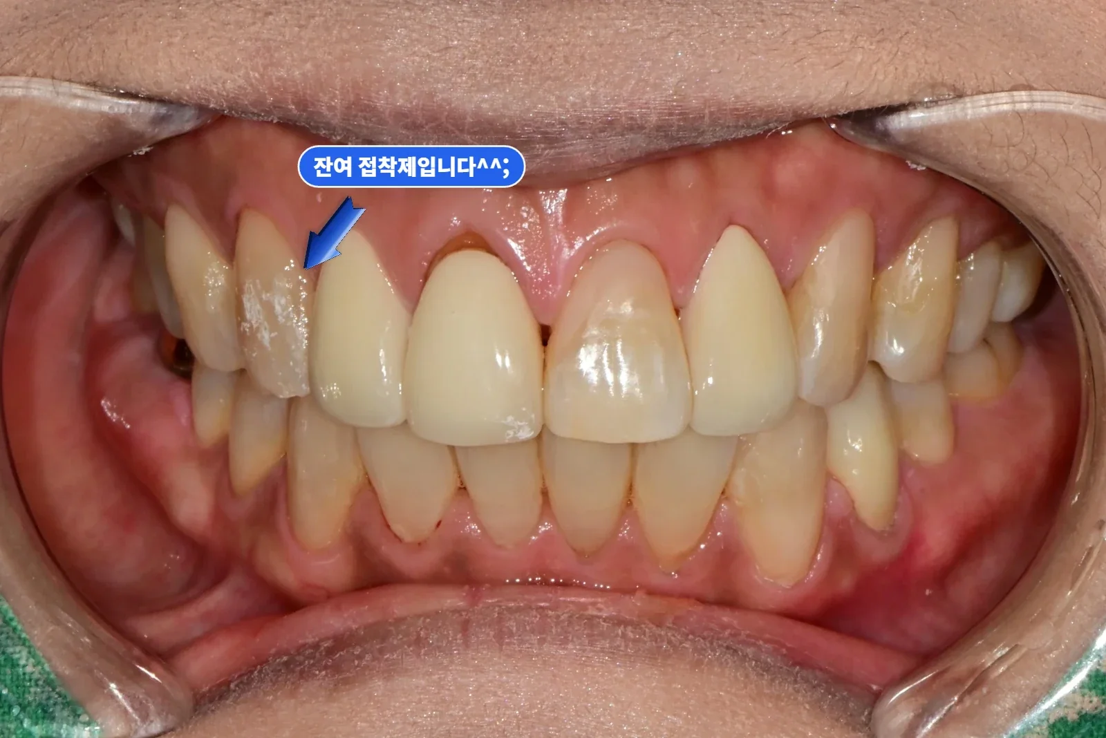 치료 후 정면