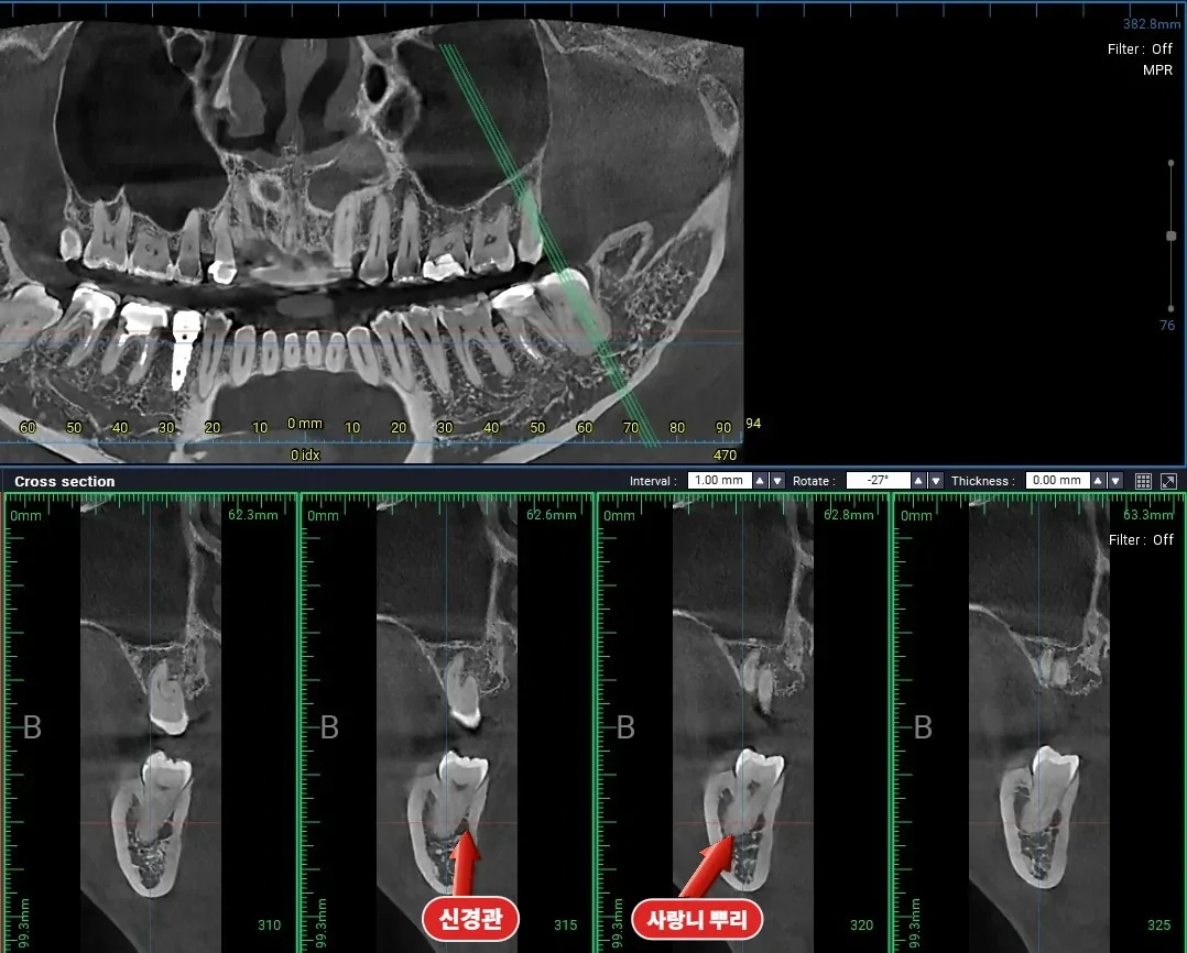 완전매복 사랑니와 아래턱 신경관의 관계를 확인한 3D CT 단면
