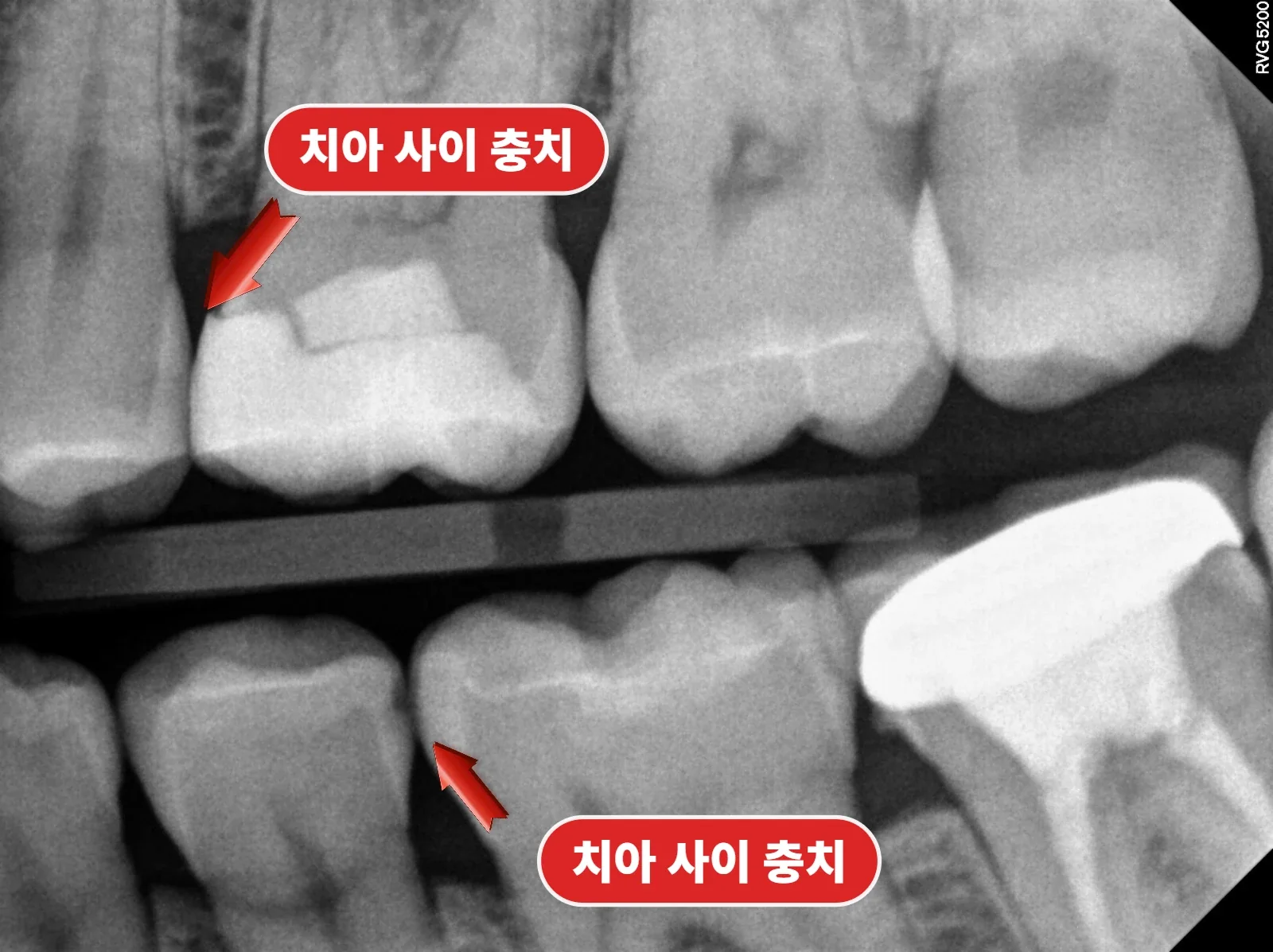 치아 사이 인접면 충치와 인레이 계획을 확인한 왼쪽 교익촬영