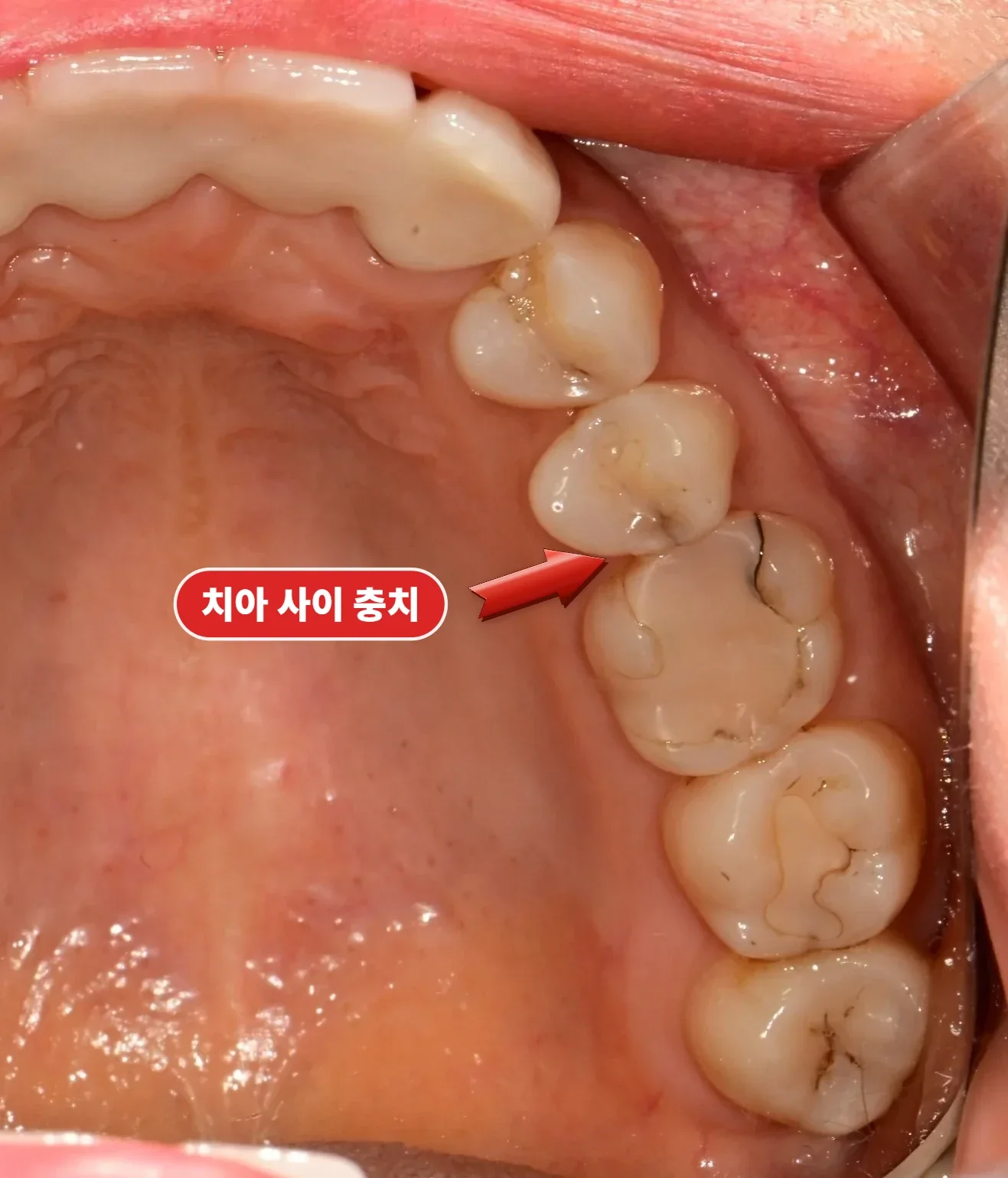 레진·세라믹 인레이 계획 기준이 된 치료 전 위턱 교합면