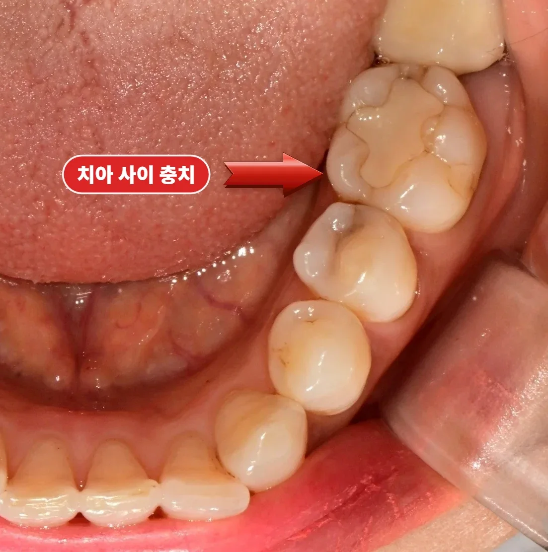 인접면 충치가 드러난 치료 전 아래턱 교합면