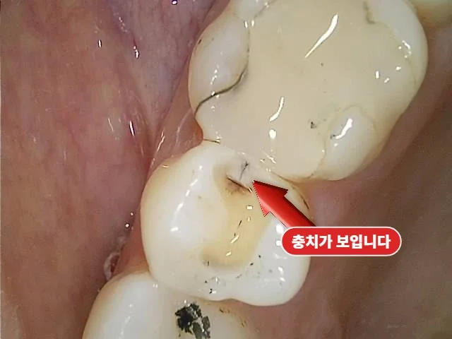 왼쪽 위 세라믹 인레이 진행 중 실제로 확인된 인접면 충치