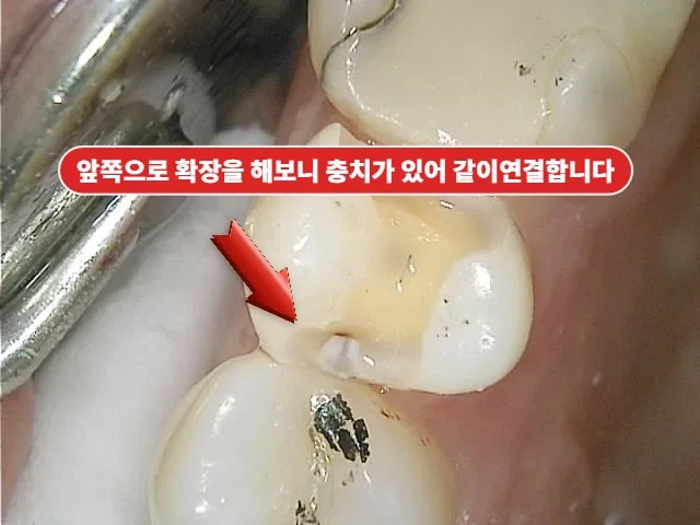 왼쪽 위 치아 한쪽 충치를 제거하며 추가로 확인된 반대쪽 인접면 충치