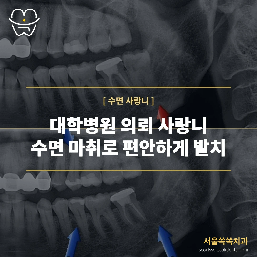 아래턱 신경관에 가까운 완전매복 사랑니를 의식하 진정요법(수면)으로 발치한 실제 진료 기록