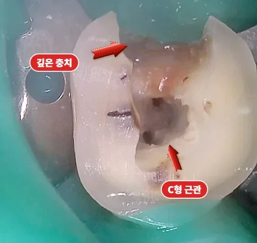 러버댐 격리 후 신경관 입구를 연 모습