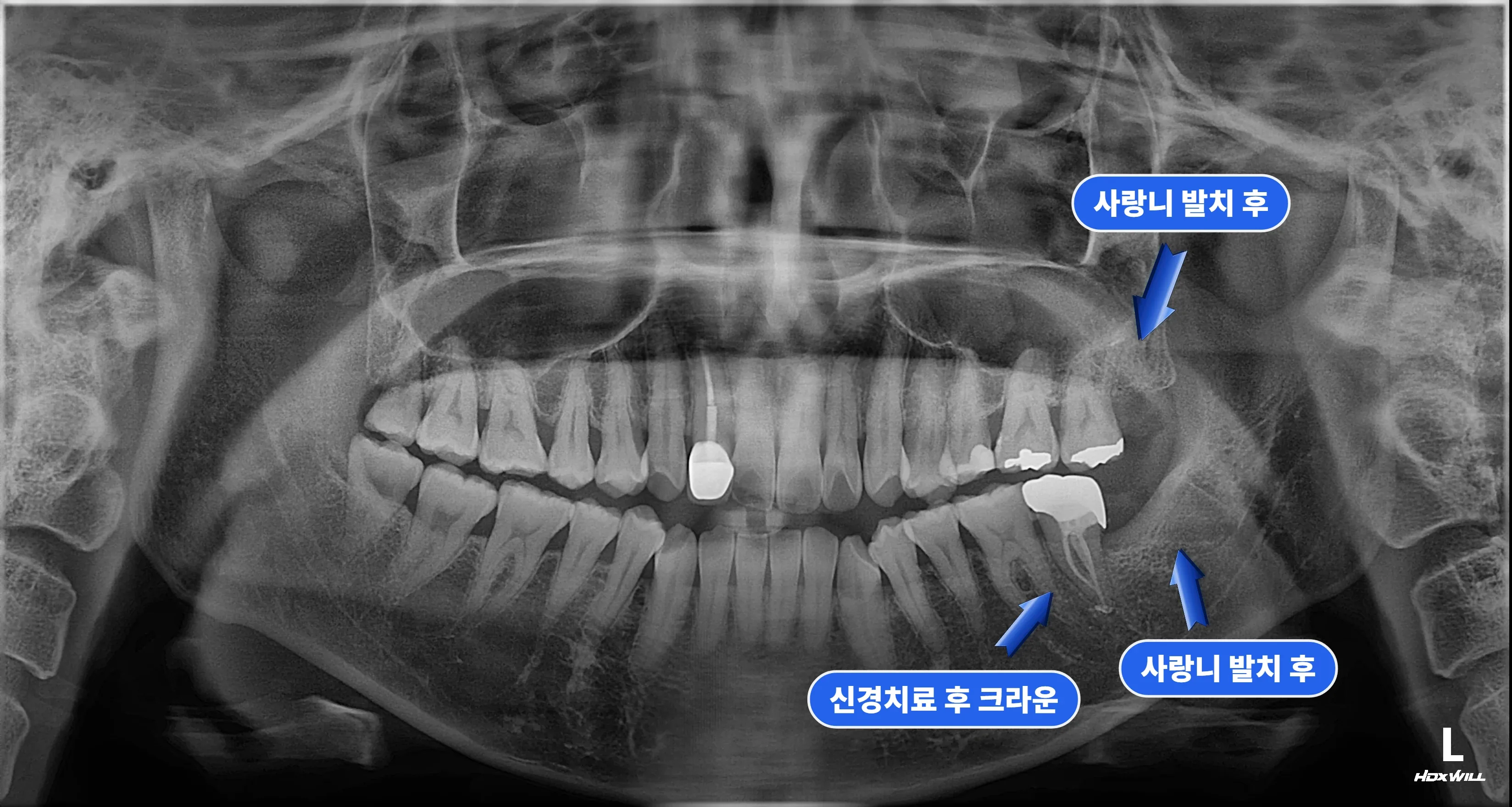 치료 후 파노라마, 사랑니 발치와 크라운 마무리 상태